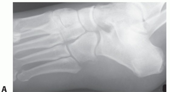 Solving Middle Facet Coalition Pain with Adult Resection
