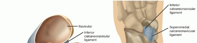 Spring Ligament Reconstruction: Regain Foot Stability
