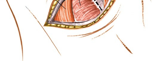 Illustration 8 for Mastering the Anterior Cervical Approach: Longus Colli Muscle Insights