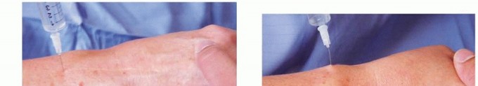  Wrist Denervation