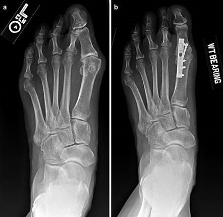 Illustration 56 for First Metatarsal Surgery: Expert Solutions for Foot & Ankle Pain