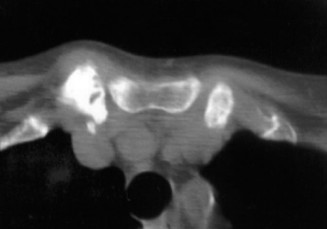 Illustration 50 for Right Shoulder Pain? Avoid This Common X-ray Mistake.