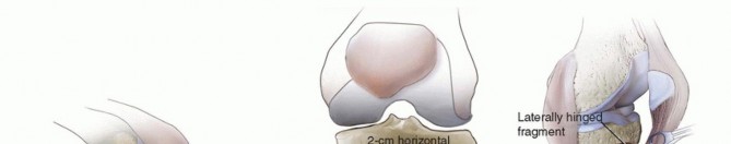 Illustration 9 for Tibial Tubercle Osteotomy: The Key to Extensile Exposure in Revision TKA