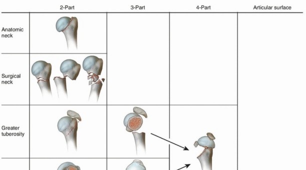Optimize Twopart Surgical Neck Fracture Fixation with IM Nailing