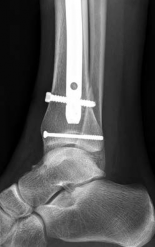 Illustration 32 for Tibial Fracture Extending into the Plafond: Intramedullary Secrets