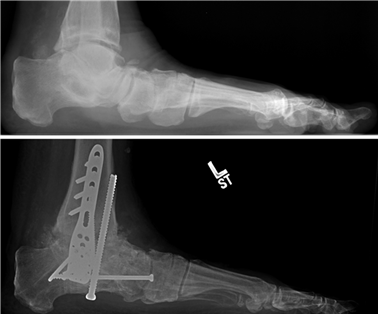 Illustration 113 for First Metatarsal Surgery: Expert Solutions for Foot & Ankle Pain
