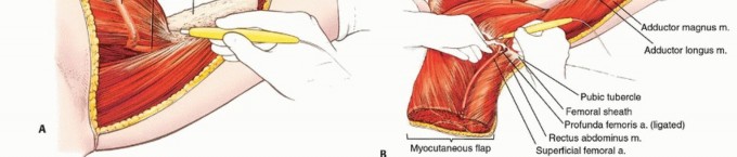 صورة طبية: استئصال نصف الحوض بالرفرفة الأمامية: حلول متقدمة لأورام الحوض الصعبة مع الأستاذ الدكتور محمد هطيف في صنعاء