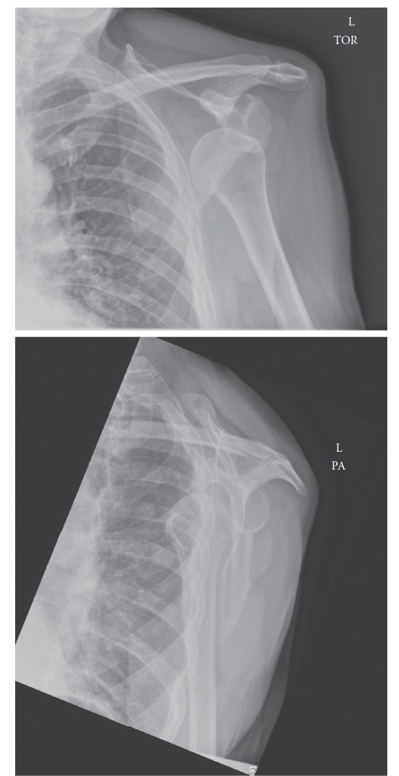 Anterior Glenohumeral Dislocation: Comprehensive Guide to Epidemiology, Anatomy, Biomechanics & Management