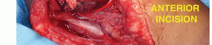 صورة طبية: استئصال الجزء البعيد من عظم العضد: تقنيات آمنة للحفاظ على الطرف في صنعاء مع الأستاذ الدكتور محمد هطيف