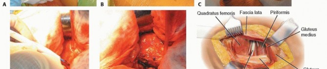 صورة طبية: نصف مفصل الورك: دليلك الشامل لدواعي الاستخدام والأنواع في صنعاء