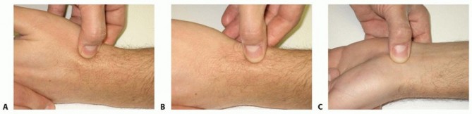 Vascularized Bone Grafting of Avascular Scaphoid Nonunions