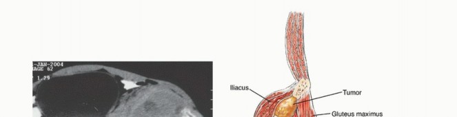 توضيح طبي: جراحة نقائل الحوض: حل شامل لآلام العظام واستعادة الحركة مع الأستاذ الدكتور محمد هطيف