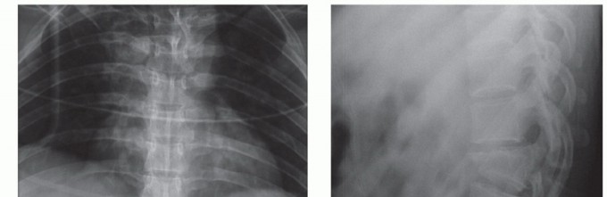 Illustration of costotransversectomy for canal - Dr. Mohammed Hutaif