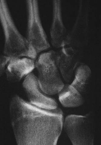 Illustration 21 for Christine M Kleinert Discussion: Solving Difficult Wrist Fractures