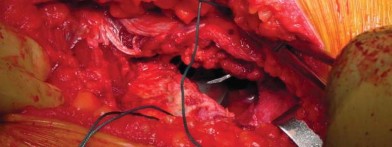 صورة طبية: تقنية الجذع القصير لاستبدال مفصل الورك الكلي: نهج الأستاذ الدكتور محمد هطيف لتدخل جراحي أقل ونتائج أفضل