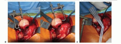 صورة طبية: ترميم مفصل الورك: الحل الأمثل للحفاظ على عظم رأس الفخذ في صنعاء مع الدكتور محمد هطيف