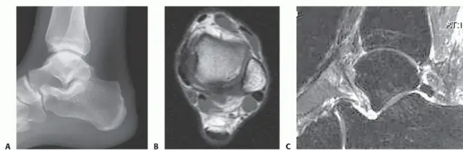 وداعاً لألم الكعب المزمن: الدليل الشامل لمتلازمة هاغلوند وعلاجها بالمنظار مع الأستاذ الدكتور محمد هطيف