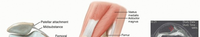 Illustration of chronic patellar instability - Dr. Mohammed Hutaif