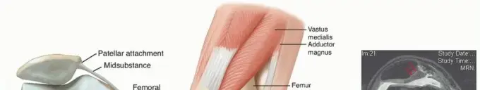 عدم استقرار الرضفة (خلع صابونة الركبة): دليلك الشامل للتشخيص والعلاج والتعافي مع الأستاذ الدكتور محمد هطيف