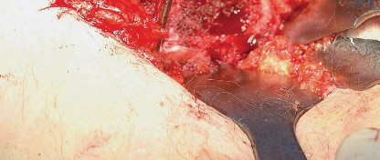 Illustration 49 for Unlock the Figure Posterior Approach to the Hip