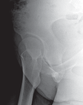 Illustration 12 for Bernese PAO: Unlocking the Procedure with Level V Evidence Insights