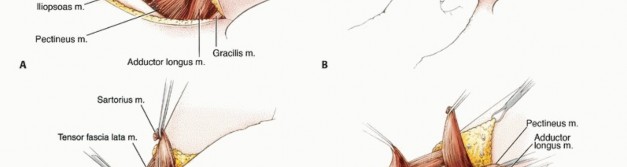 صورة طبية: استئصال مفصل الورك: دليل شامل للمرضى مع الأستاذ الدكتور محمد هطيف