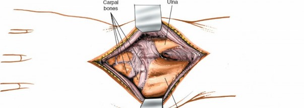 Illustration 26 for Dorsal Wrist Approach: Expert Access to the Column of the Distal Radius
