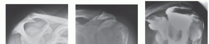 Subscapularis & Teres Rotator Cuff Repair: Advanced Techniques