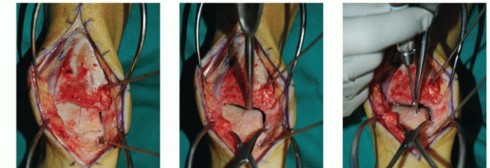 Illustration 38 for Unlock Healing: Medial Malleolar Osteotomy for Talus OLT Allografts