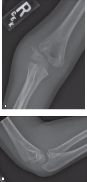 Illustration 2 for Pediatric Elbow Cases: Why the Internal Oblique View is Key