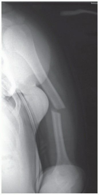 Optimizing Plate Fixation of Humeral Shaft Fractures