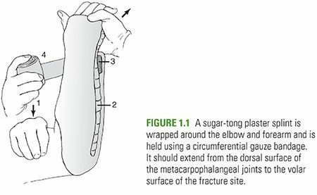 Closed Reduction Casting: Master Techniques & Principles