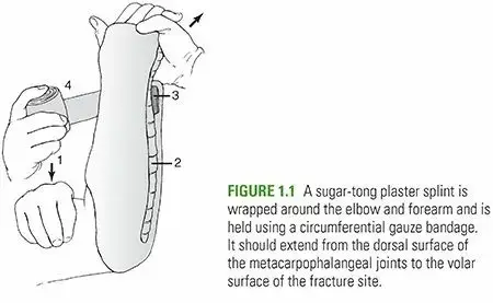 صورة توضيحية لـ كسور العظام: الدليل الشامل لرد العظام المغلق والتجبير والشد – مع الأستاذ الدكتور محمد هطيف