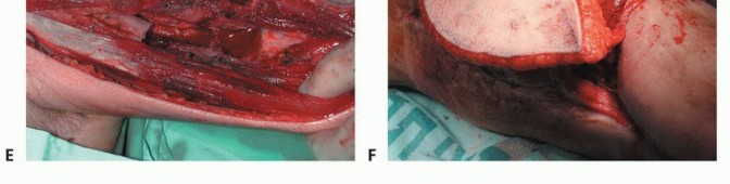 صورة طبية: ترقيع الشظية الوعائي الحر: حلول متقدمة لعيوب العظام المعقدة