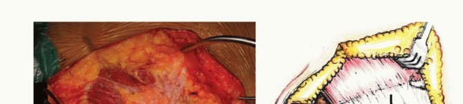 صورة توضيحية لـ جراحة أورام العجز: الحفاظ على وظائف الأمعاء والمثانة مع الأستاذ الدكتور محمد هطيف في صنعاء