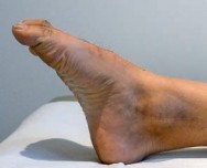 Illustration 16 for Partial Articular Fractureplate Fixation: Restore Anatomy