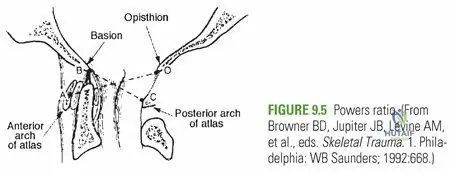 Illustration of occipitoatlantal dislocation craniovertebral - Dr. Mohammed Hutaif