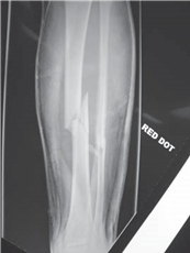 Illustration 10 for Ace Your FRCS: Key Questions in Trauma & Orthopaedics