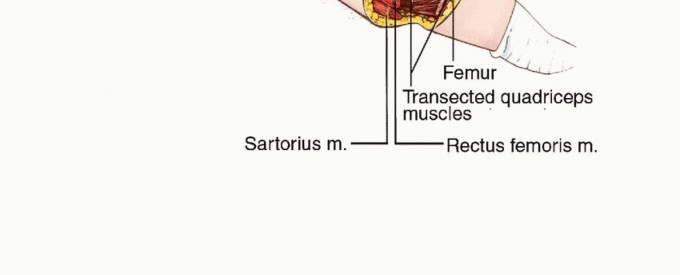 صورة توضيحية لـ استئصال نصف الحوض بالرفرفة الأمامية: حلول متقدمة لأورام الحوض الصعبة مع الأستاذ الدكتور محمد هطيف في صنعاء