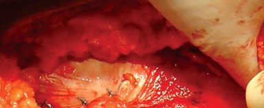 Illustration 35 for Posterolateral Surgical Approaches: Achieve Optimal Hip Replacement