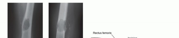 صورة توضيحية لتشريح عظم الفخذ