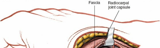 Illustration 196 for Essential Surgical Approaches: Uncover Every Aspect of the Wrist