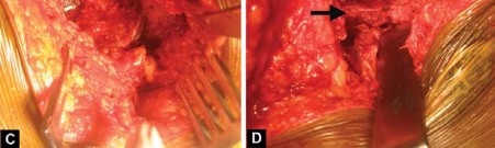 صورة طبية: استبدال مفصل الورك الكلي لالتهاب المفاصل الروماتويدي اليفعي: استعادة الحركة والأمل مع الأستاذ الدكتور محمد هطيف في صنعاء