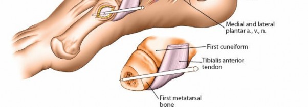 Illustration 37 for Expert Guide: Ulna and Wrist External Fixation Pin Placement
