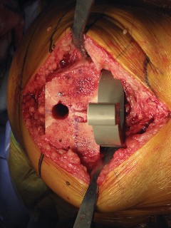 Illustration 38 for Posterior Stabilized Technique: Essential Insights for TKA Success