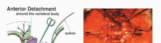 Illustration 19 for Total En Bloc Spondylectomy: Complete Resection for Spinal Tumors