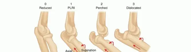 صورة توضيحية لـ خلع الكوع البسيط: دليلك الشامل من التشخيص إلى التعافي التام مع الأستاذ الدكتور محمد هطيف