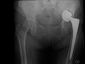 The Painful Total Hip Arthroplasty: Etiology, Anatomy, Biomechanics, and Management
