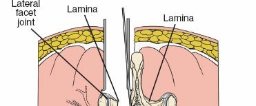 Illustration of minimally invasiveposterior approach - Dr. Mohammed Hutaif