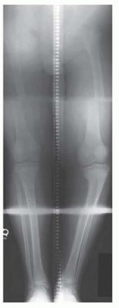 Solving Infantile Blount Disease: Surgical Management Strategies